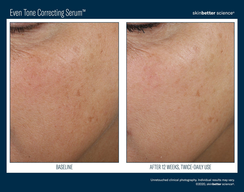 Even Tone Correcting Serum™ - skinbetter science® Canada distributed by Evolve Medical-skinbetter science®