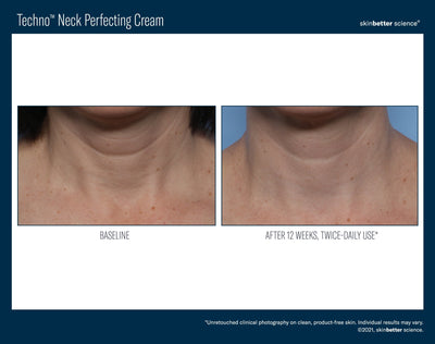 Techno™ Neck Perfecting Cream - Evolve Medical Inc. - Official Distributor of skinbetter science® Canada-skinbetter science®